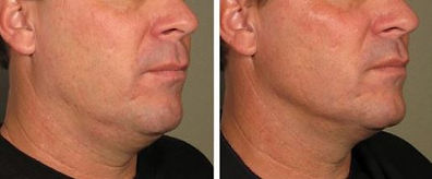 Cryo BA mandoublechin (1).JPG
