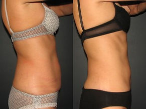Cryo BA womanwaist.JPG