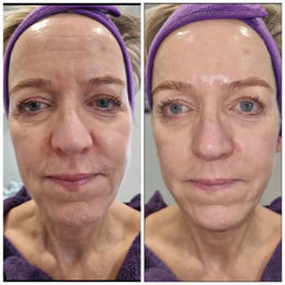 Before & After Cryoskin