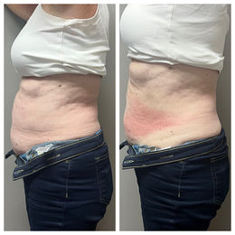 Before & After Cryoskin