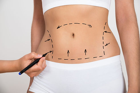 Liposuction.jpg