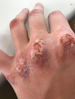 Special effects blistered hand.
