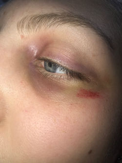 Black eye.