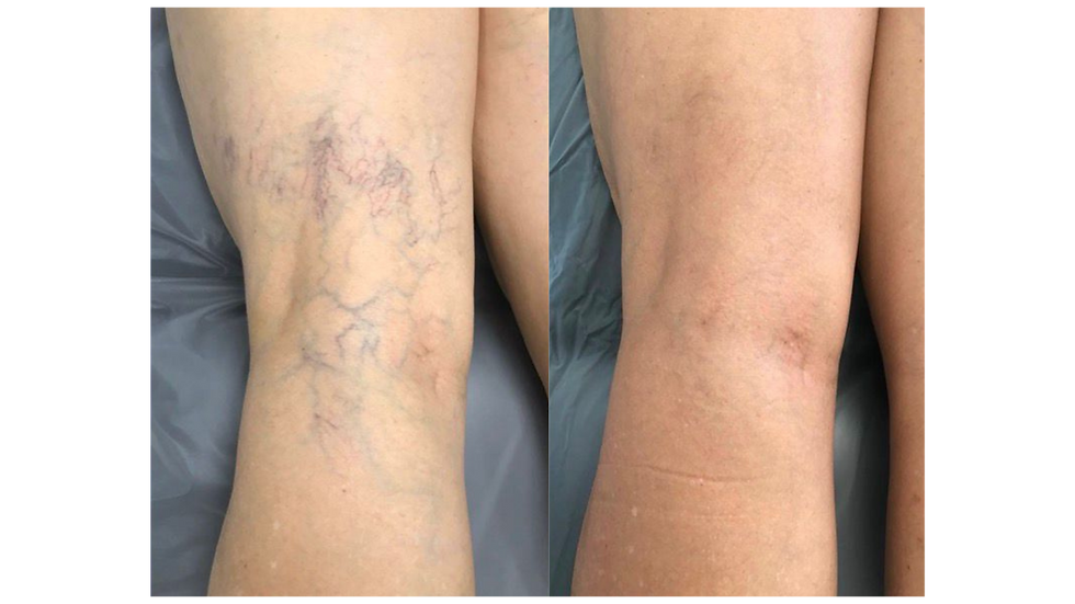 Antes e depois CLaCS