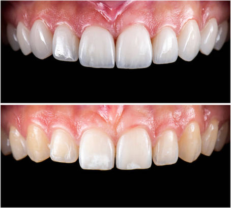 Dental bonding results Melbourne - before and after photos showing cosmetic improvement of front teeth at Bare Smiles Dental