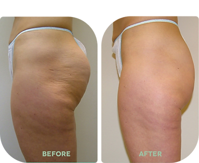 Velashape III Before & After