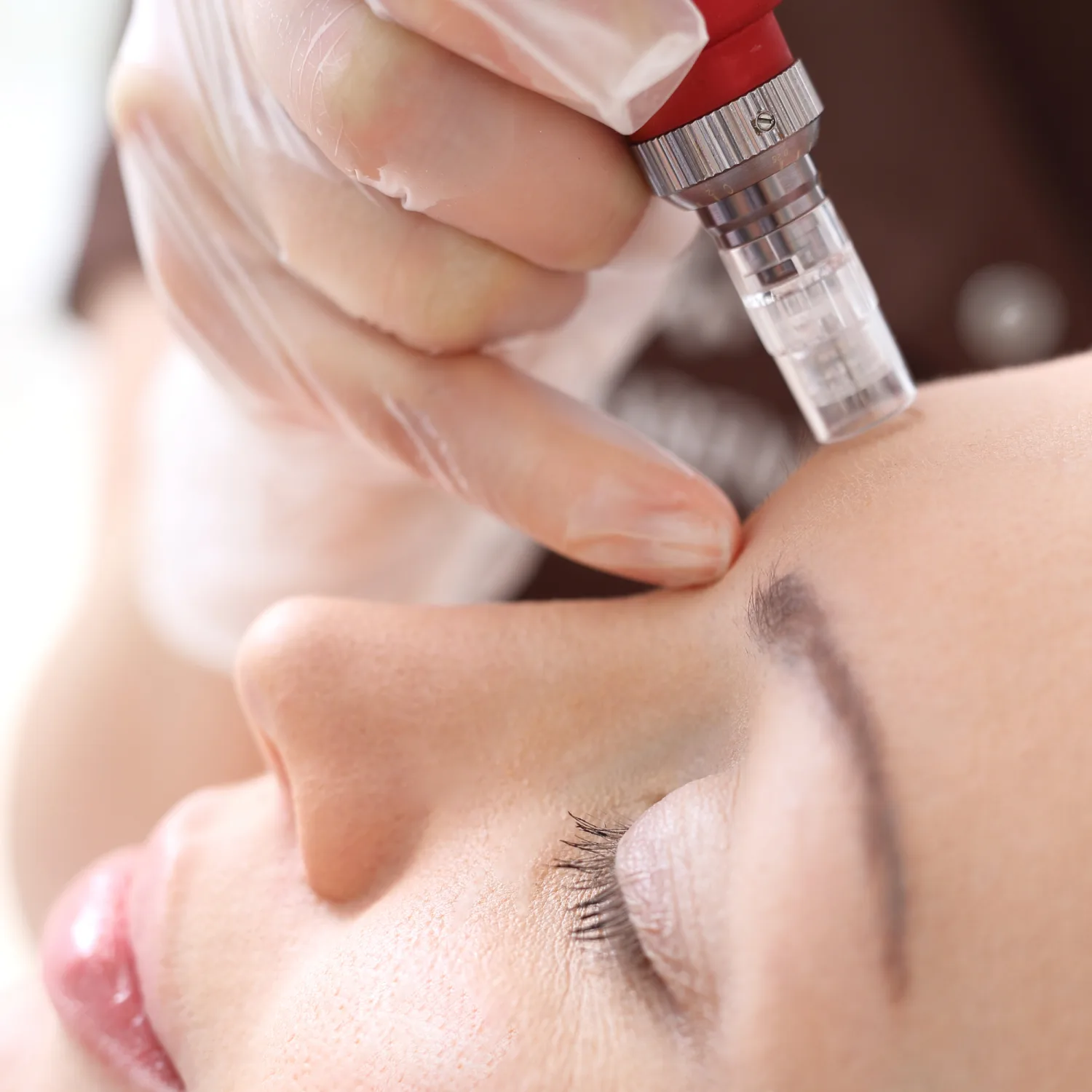 Microneedling procedure