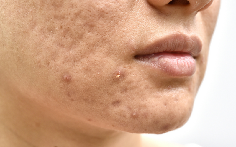 Flawless Skin Awaits: Your Guide to Acne Scar Treatments