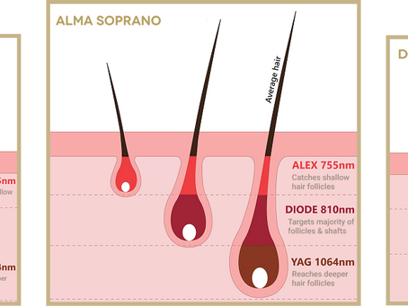 Triple Wavelength Laser Hair Removal That Works for Everyone