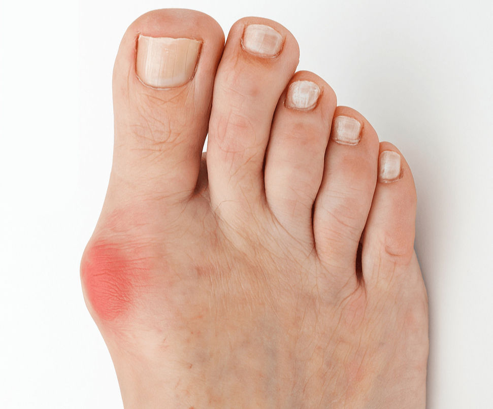 A close-up image of a human foot showing a red, swollen bump near the base of the big toe, likely indicating a bunion.
