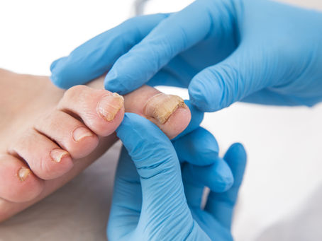 Toenail Fungal Infection (Onychomycosis)