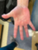 Incision after 3 months