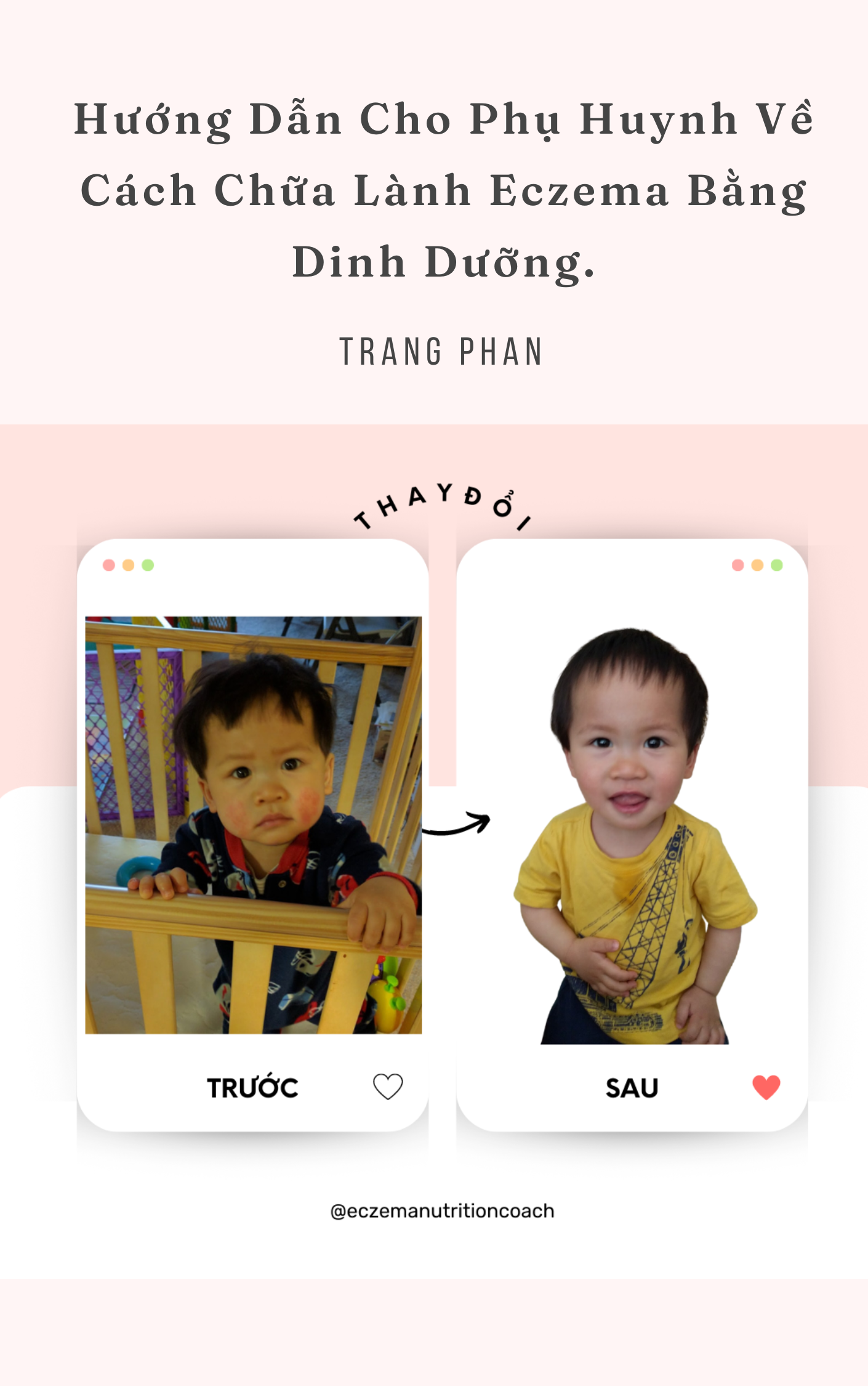 Hướng Dẫn Cho Phụ Huynh Về Cách Chữa Lành Eczema Bằng Dinh Dưỡng