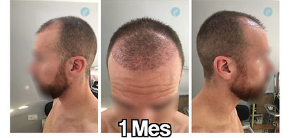 1evolución-de-injerto-capilar-mes-a-mes-