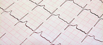 Ekg.jpg