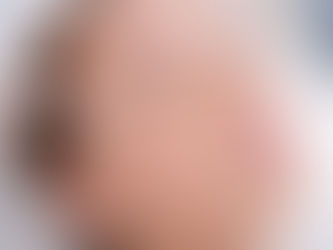 The Ins and Outs of Botox: What You Need to Know