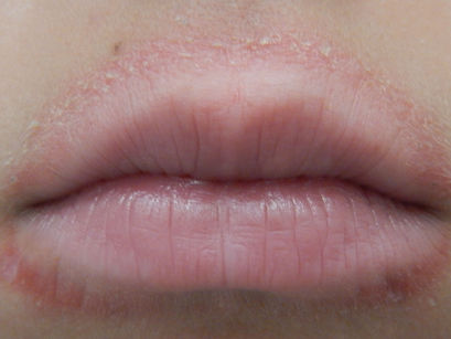 Perioral dermatitis: A nagging red rash on the face