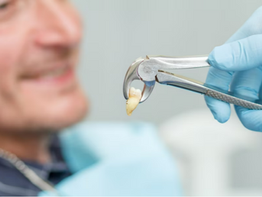 To Pull or Not to Pull: Understanding the Reasons for Tooth Extraction