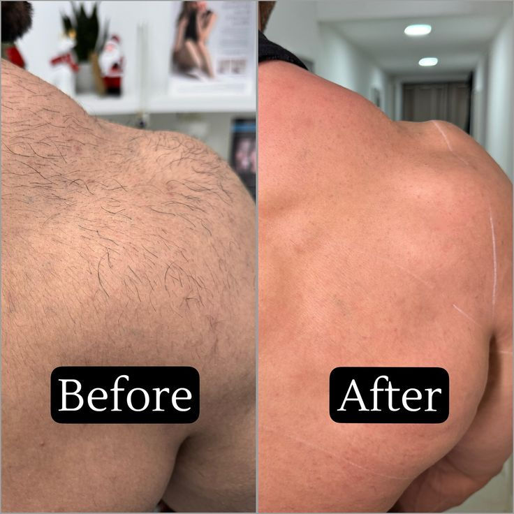 épilation laser homme dos nuque action professionnelle Aix-en-Provence