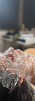 Microneedling, medical micro needling, Charlotte, NC