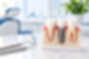 How Long Do Dental Implants Last?
