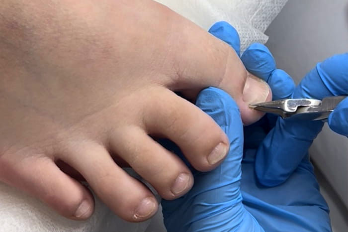 Ingrown Nail image