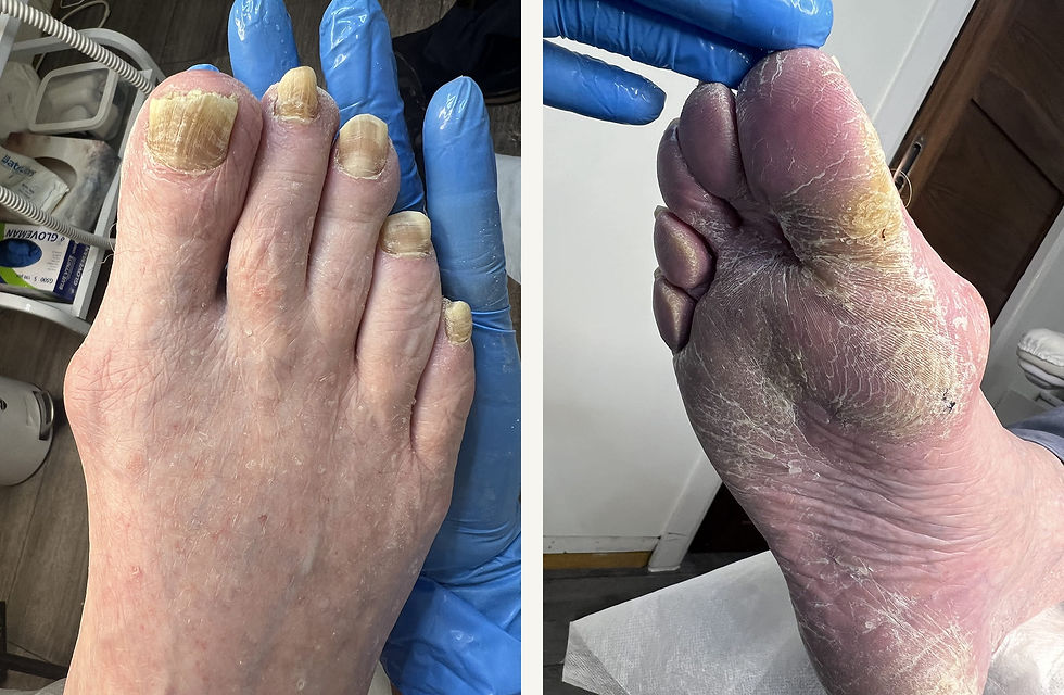 Close-up of feet with thick, discolored toenails and dry skin. Gloved hands hold the feet. Clinical setting in the background.
