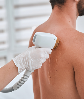 Epilation lazer IPL