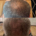 PRF Hair Restoration