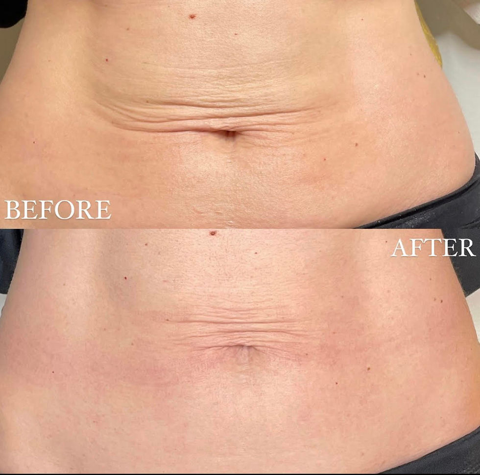 RF Microneedling Stomach
