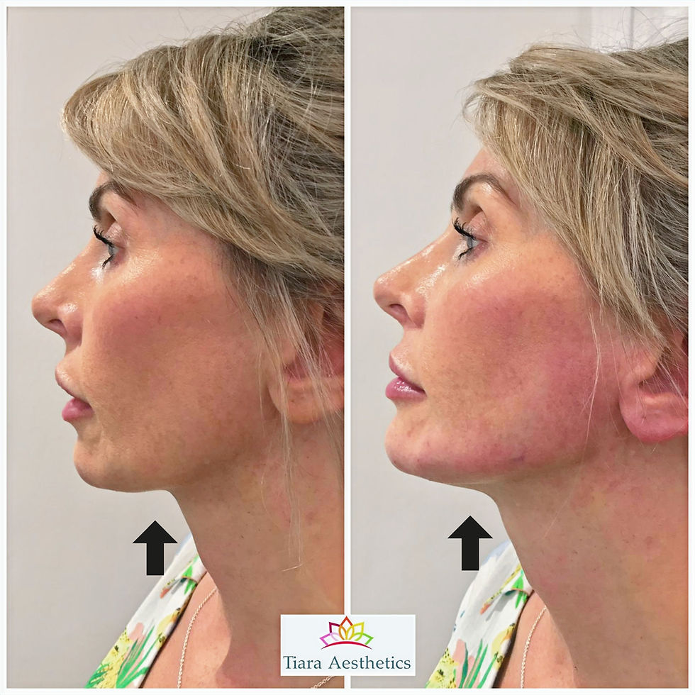 Jawline contouring results creating a stronger profile