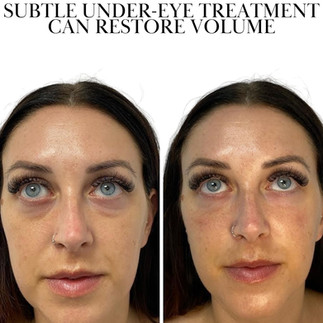 Tear trough filler before after reducing hollow under eyes with natural refreshed result