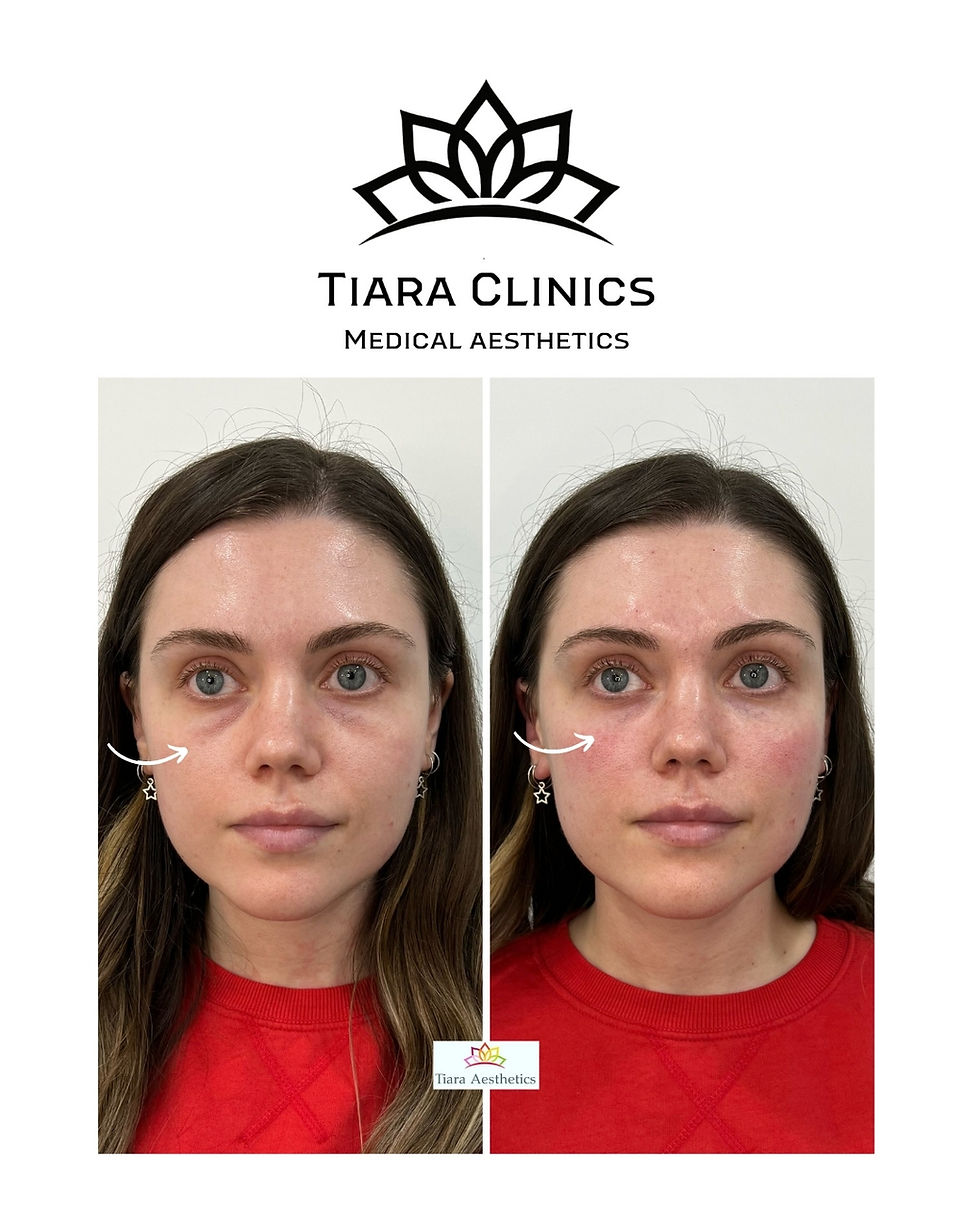 Before and after eye area treatment restoring volume