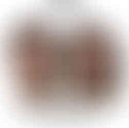 Midface filler before and after restoring volume cheeks and under eyes natural balanced results