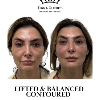 Midface filler before and after restoring volume cheeks and under eyes natural balanced results
