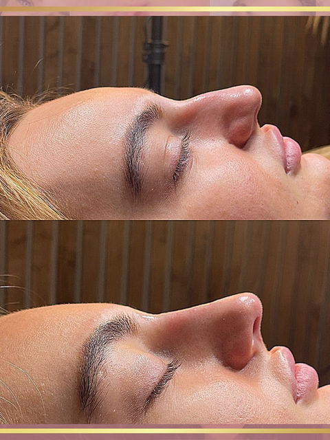 before and after results of a liquid rhinoplasty nose filler treatment carried out by dani louise aesthetics to straighten the bridge of the nose