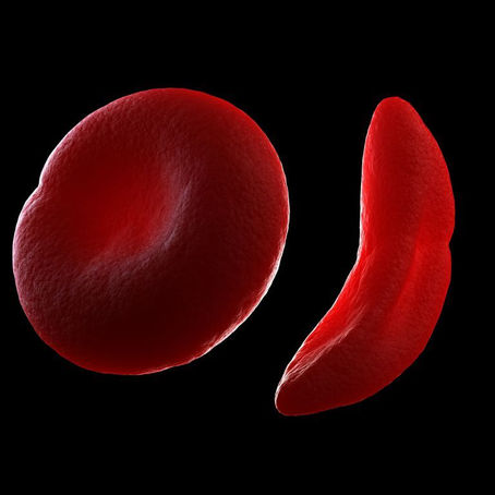 Sickle Cell Anemia in Africa: Why Awareness Still Falls Short and What We Can Do