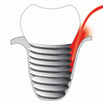 pact_peri-implantat-150x150.gif