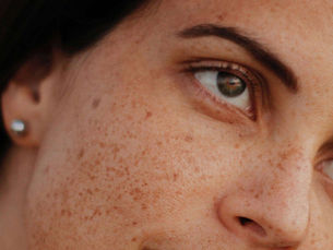 Una soluzione efficace contro le macchie solari? L'acido tranexamico. 