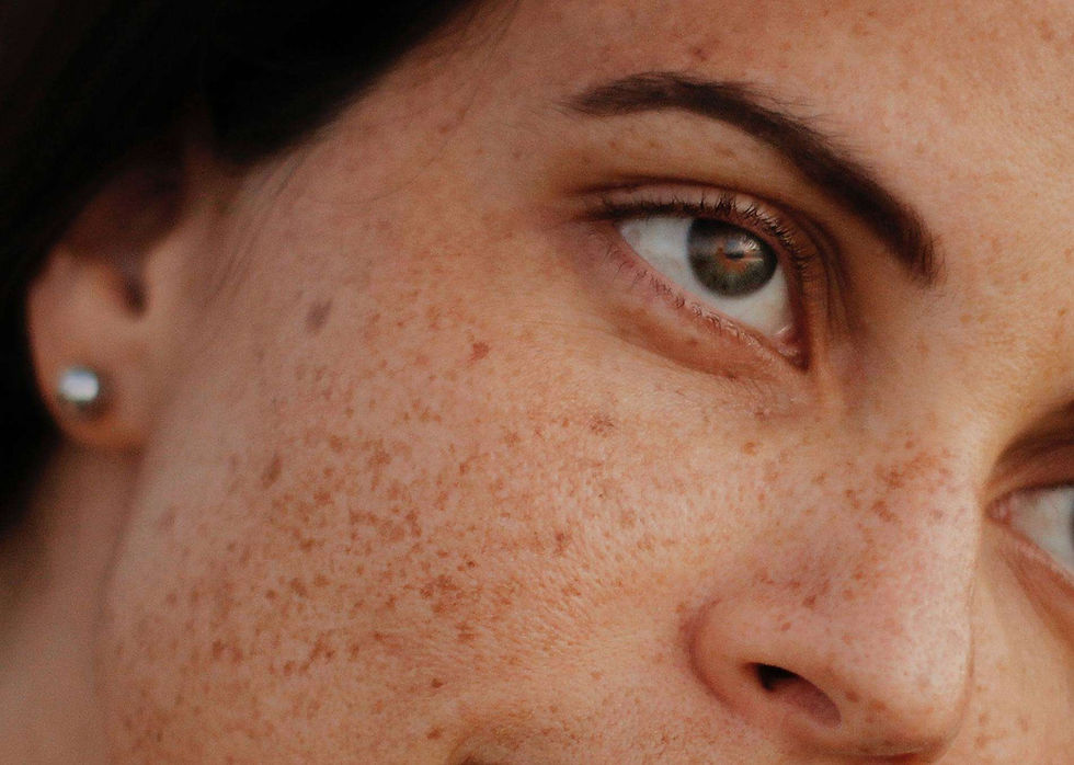 L'acido tranexamice una soluzione efficace contro le macchie solari