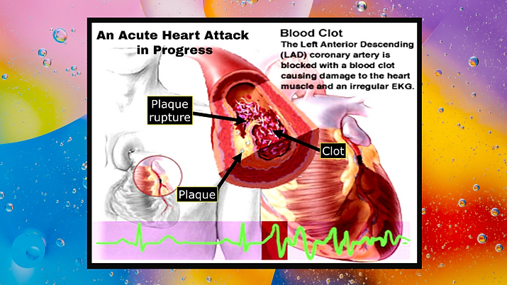 2022 Acute Heart Attack in Progress (1).png