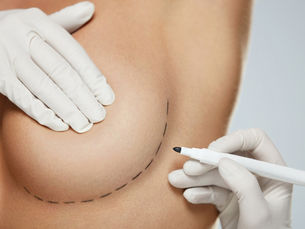 Do You Need a Breast Lift, Reduction, or Revision? How to Know the Right Procedure for You