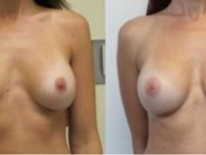 Obstacles To Natural Looking Scarless Transaxillary Results In Breast Augmentation Surgery