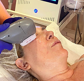 Hifu Facial La Crème