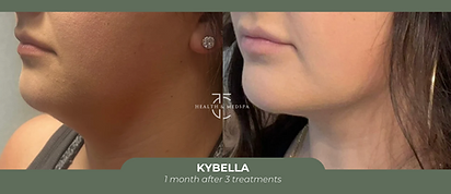 Kybella Before & After