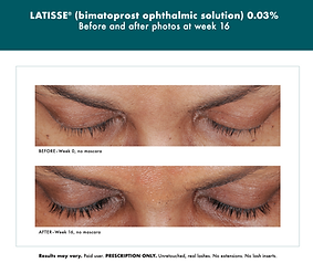 Before and after Latisse