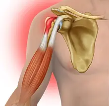 biceps tendinitis2.webp
