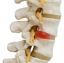 herniated-disc.jpg