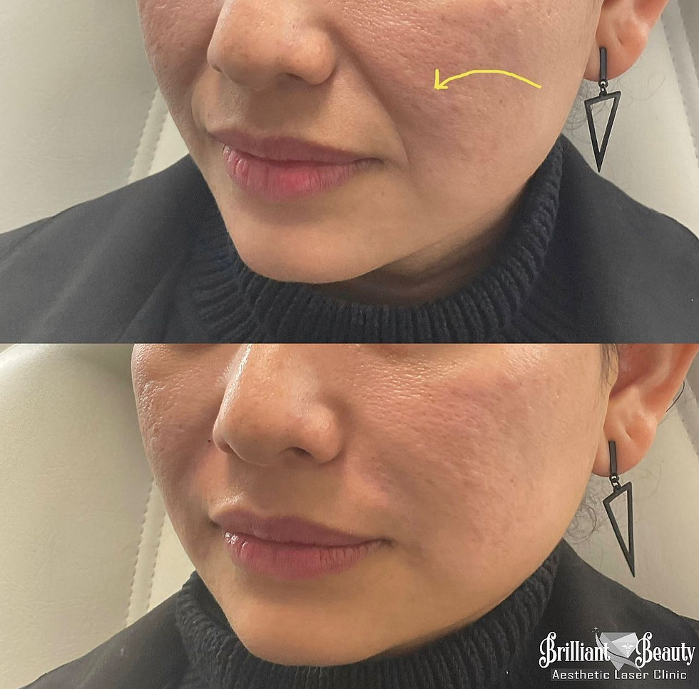 Nasolabial folds (Smile lines)