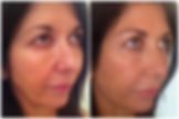 Jowl lift